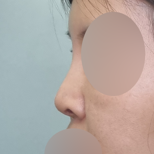 수술 전 후