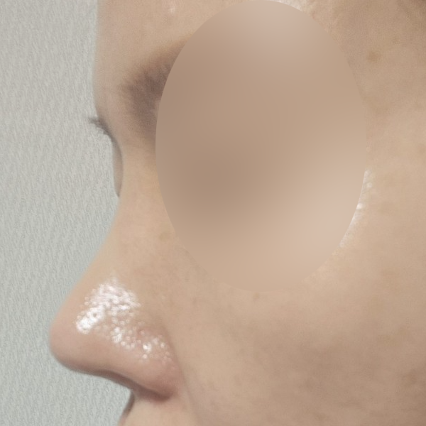 수술 전 후