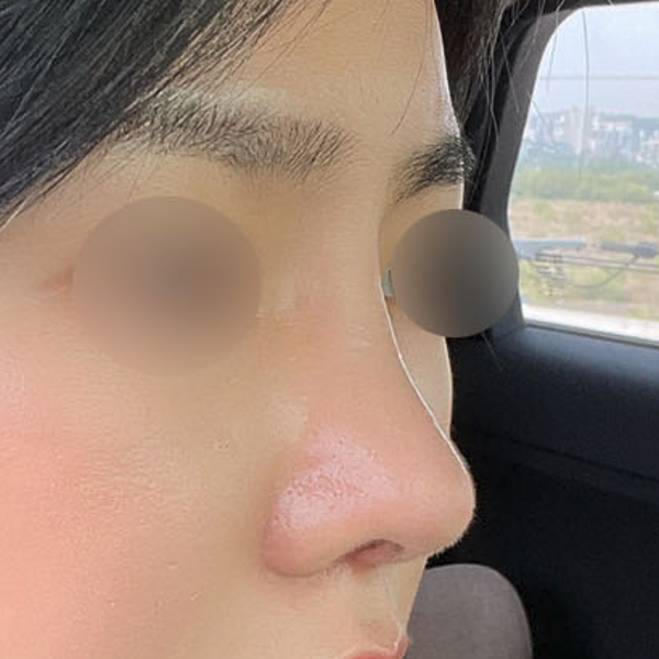 수술 전 후